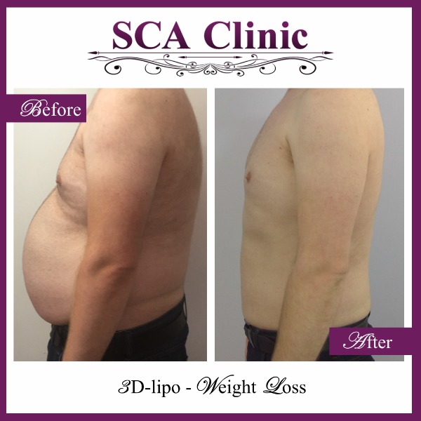 3D-lipo - Weight Loss